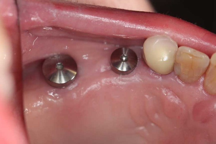 dental implants 1